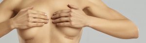 tratamiento asimetria mamaria
