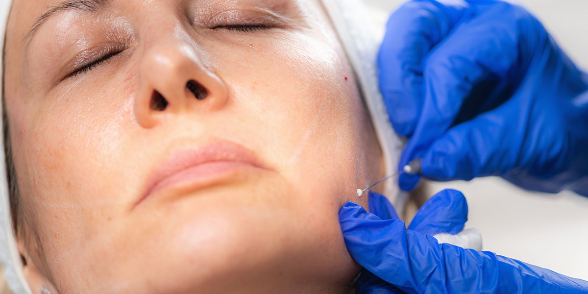 tratamiento facial mesoterapia